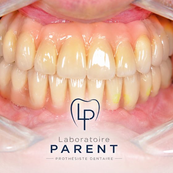 Bridge complet sur implants en zircone stratifiée