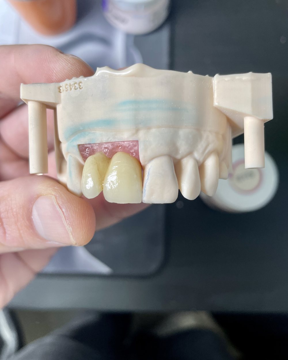 Prothèse sur implant réalisée au Laboratoire Parent