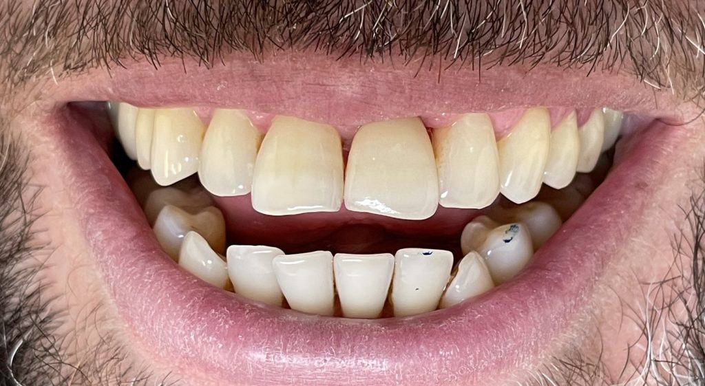 Sur implant en Zircone stratifiée