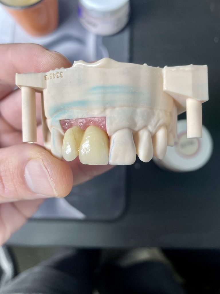 Sur implant en Zircone stratifiée