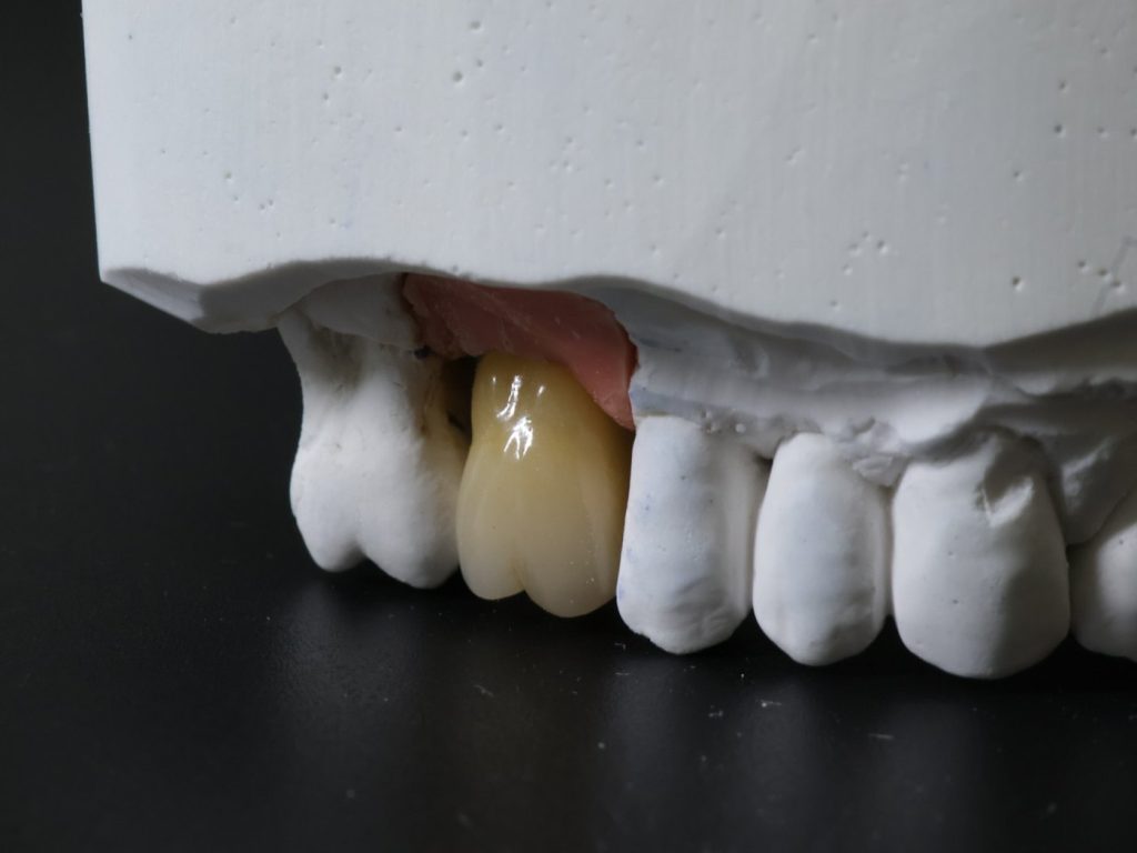 Sur implant en Zircone stratifiée