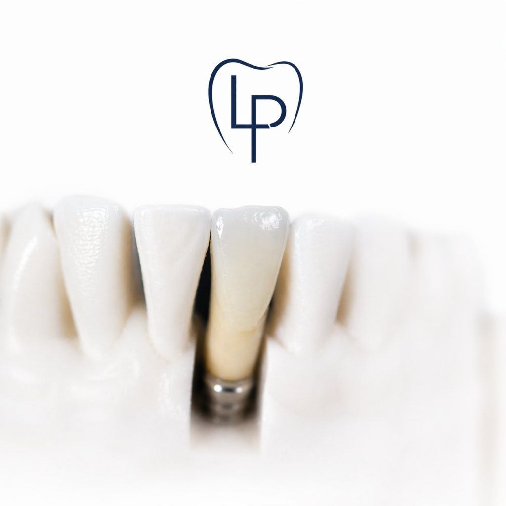 Sur implant en Zircone stratifiée