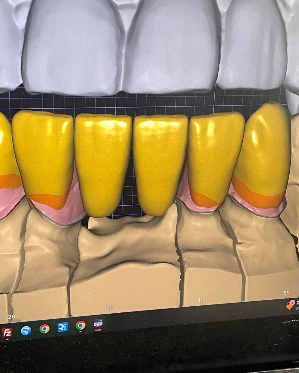 Rendu de conception CAO d'une restauration sur exocad