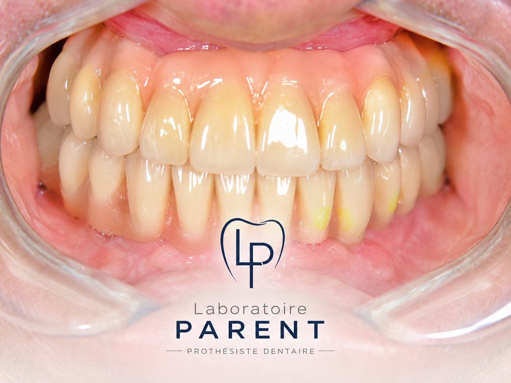 Prothèse sur implant finie à la main